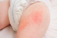 Hăm tã ở trẻ nguyên nhân do đâu? Mách mẹ cách xử trí kịp thời